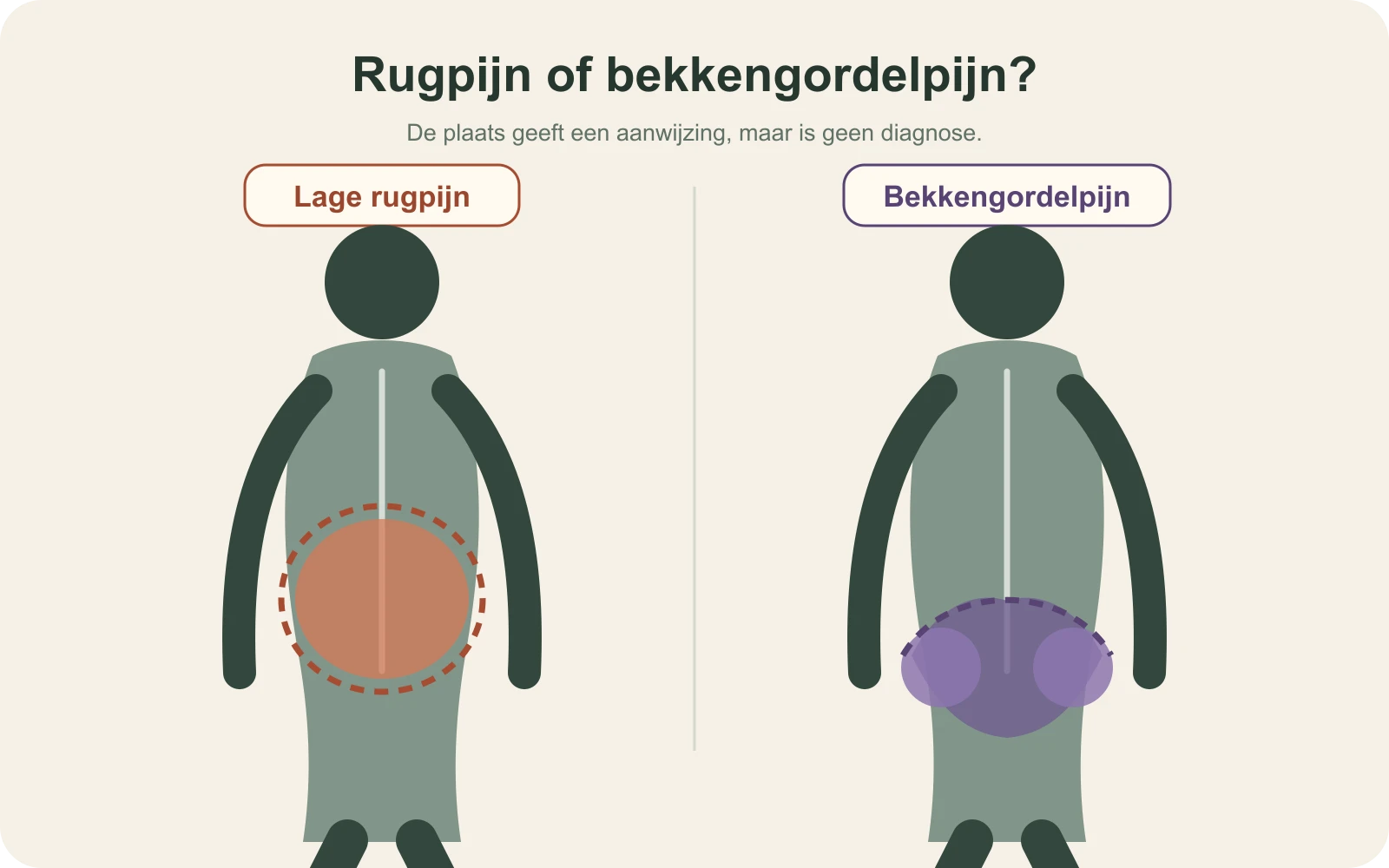 Schematische vergelijking van lage rugpijn en bekkengordelpijn tijdens de zwangerschap